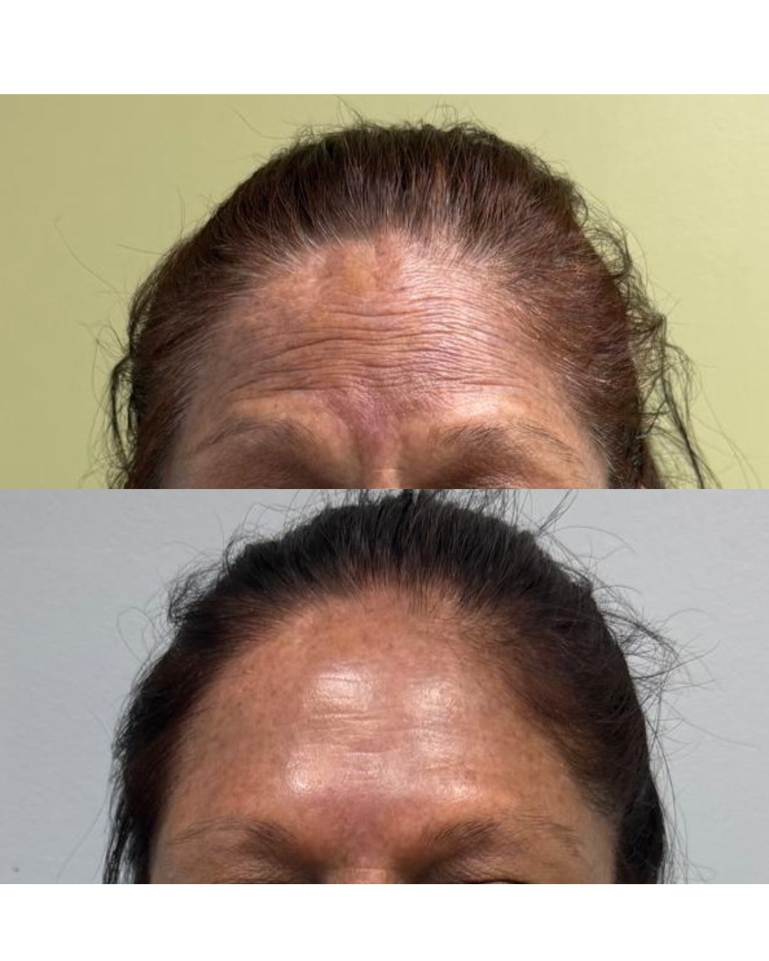Botox — Forehead before and after