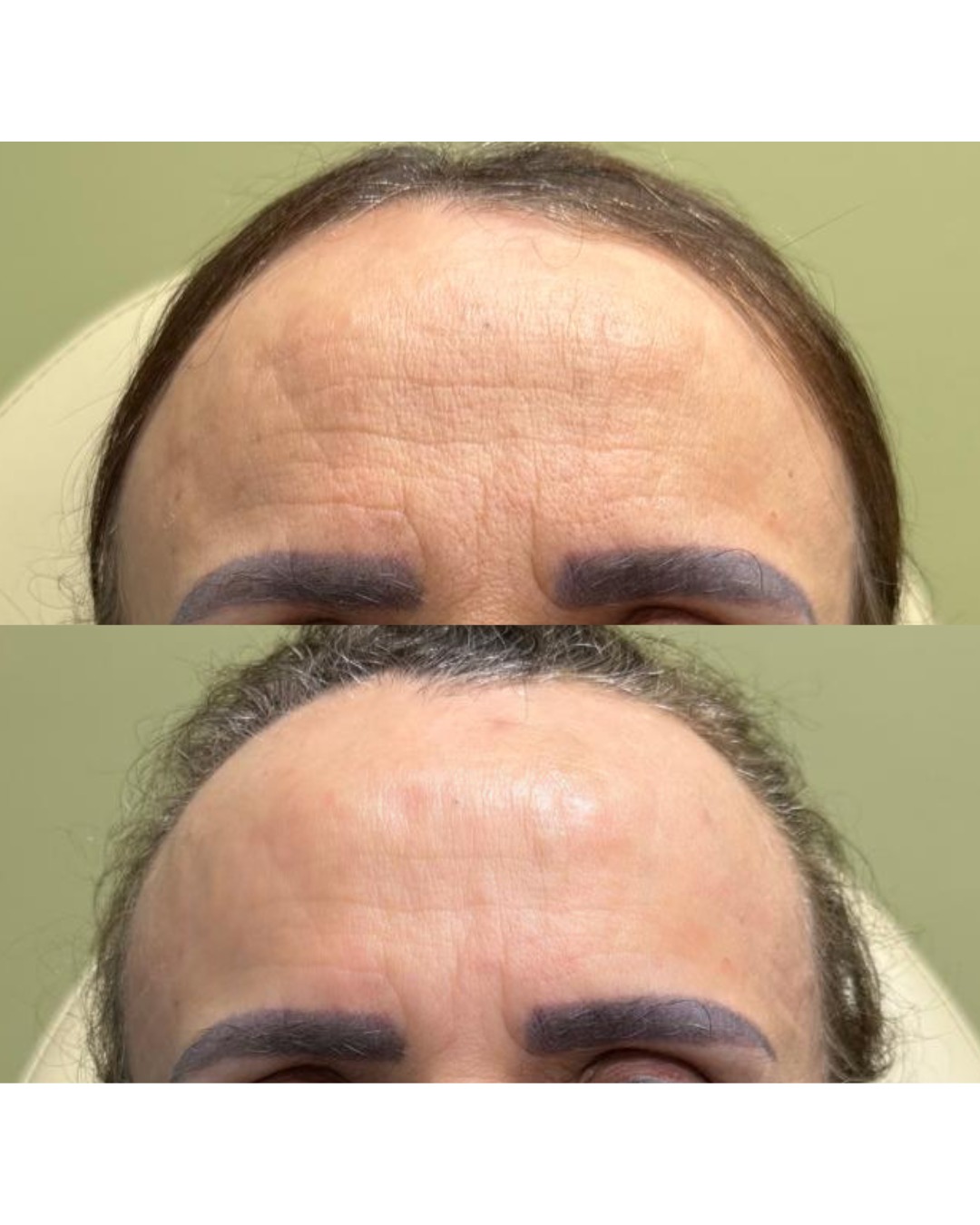 Botox — Forehead before and after