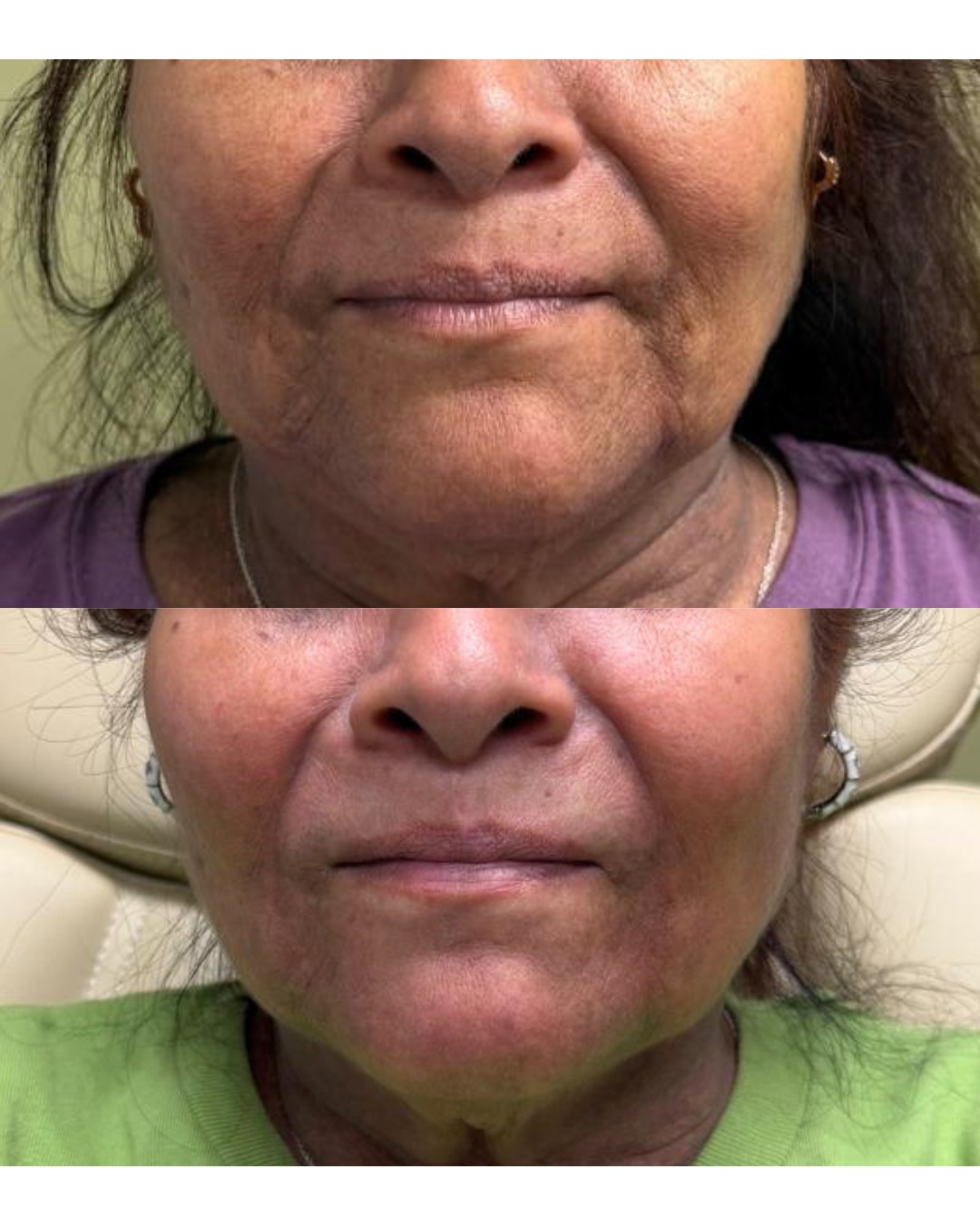 Chemical Peel before and after