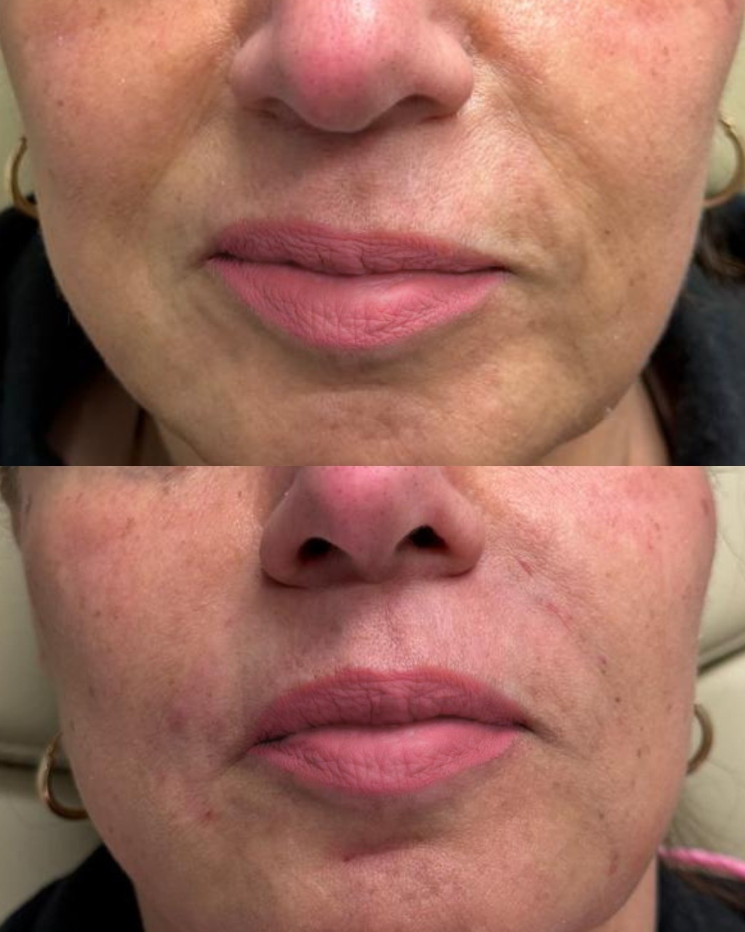 Dermal Filler — Nasolabial Folds & Lips before and after