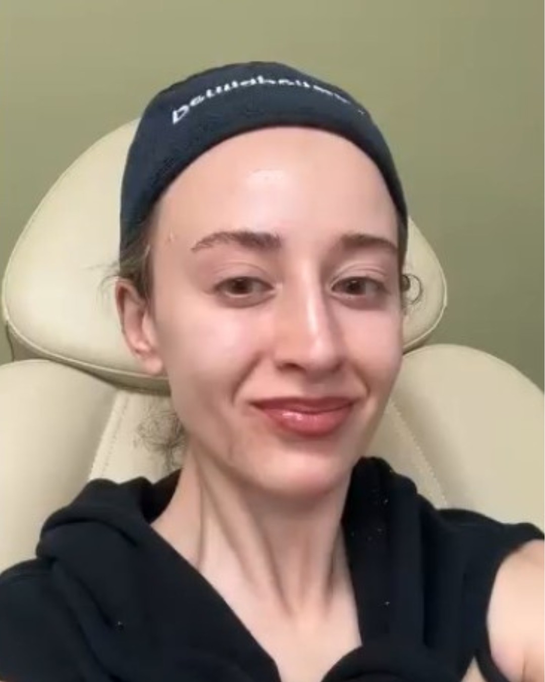 PRP with Microneedling before